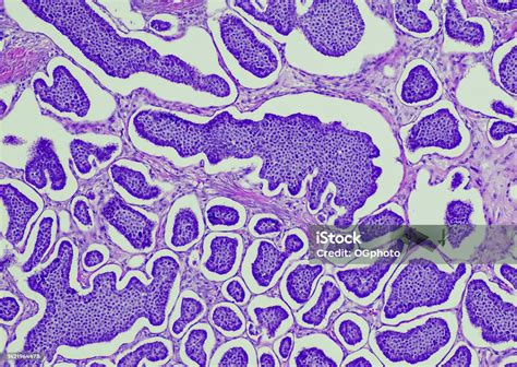 carcinoid tumor stock photo  image  cancer cell ovary