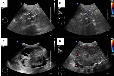 Figure From Case Report The Ultrasound Features Of Acquired Cystic