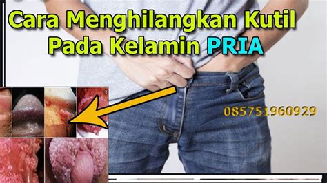 Cara Menghilangkan Penyakit Kulit Pada Kelamin Pria Kutil Youtube