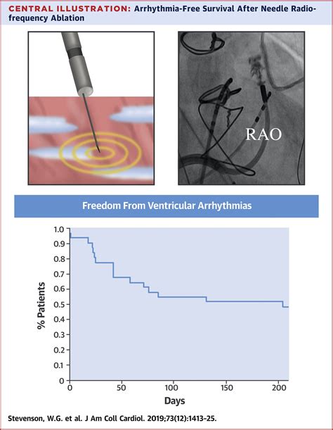 Infusion Needle Radiofrequency Ablation For Treatment Of Refractory