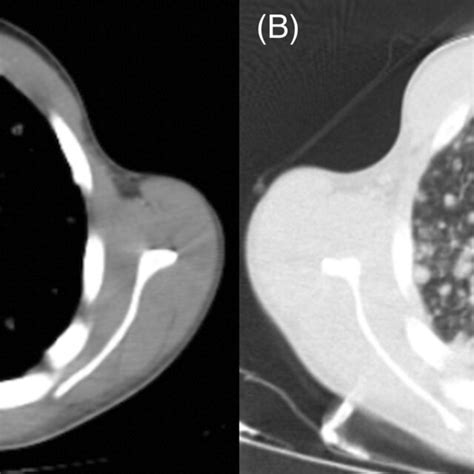 Complete Response Was Observed On Control Positronelectron Tomography