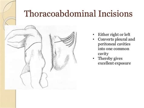 Abdominal Incisions