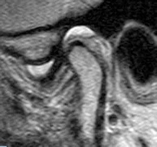 MRI TMJ JOINT – Teleradwin