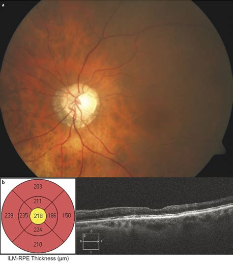 Paraneoplastic Retinopathies Ento Key