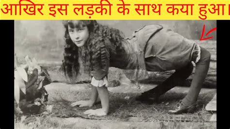 आखिर इस लड़की के साथ कया हुआ। What Happened To This Girl Amazingfacts Facts Youtubevideo