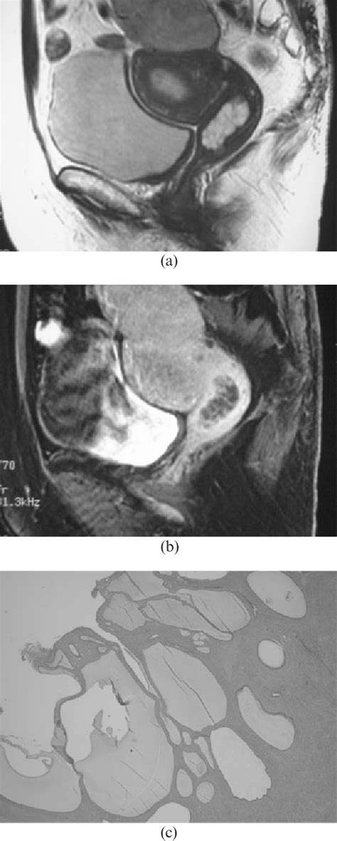 Figure 2 From Mr Findings Of Pseudoneoplastic Lesions In The Uterine