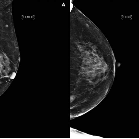 Left Mammogram Showing Masses A Mediolateral Oblique B Cranial Caudal