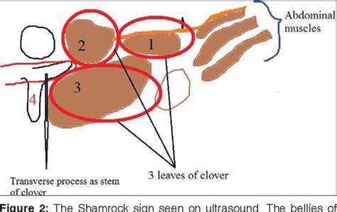 Figure From Bilateral Quadratus Lumborum Block For Post Caesarean