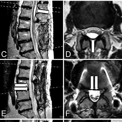 Case Sagittal A And C And Axial B And D Mri After First