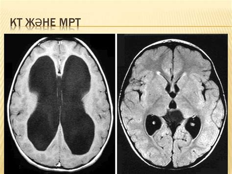 Заместительная наружная гидроцефалия головного мозга что это такое и