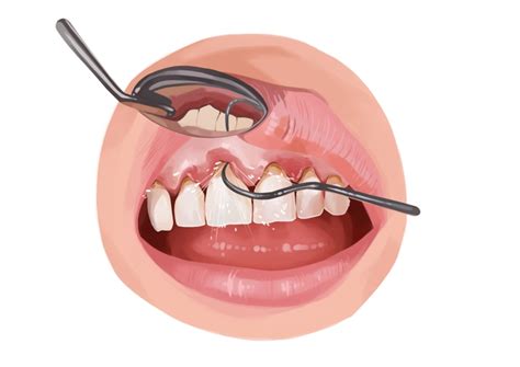 What Is Scaling And Root Planing Authority Dental