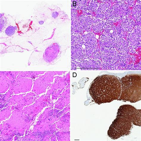 Histopathologic Images A Low Power View Showing Multiple Tumor