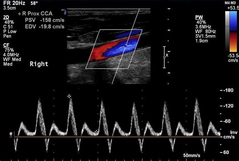 Lower Extremity Arterial Ultrasound Radiology