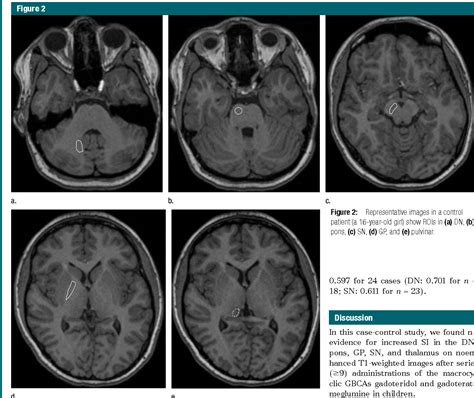 Figure 2 From Gadolinium Brain Deposition After Macrocyclic Gadolinium