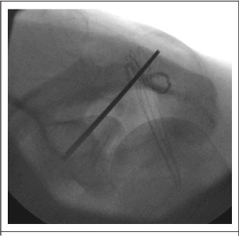 Figure 2 From Recurrent Acromioclavicular Joint Dislocation With An Associated Coracoid Fracture