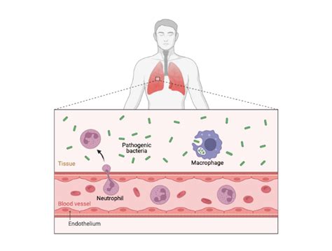 Local Bacterial Infection 2 | BioRender Science Templates