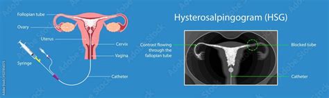 Hysterosalpingogram Hsg Test Blocked Fallopian Tubes Diagnose Tubal