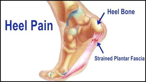 Achilles Tendon Heel Pain