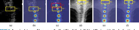 Pdf Automation Of Spine Curve Assessment In Frontal Radiographs Using