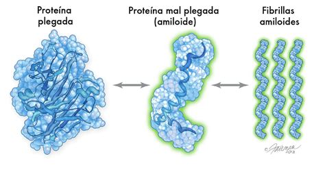 Qu Es La Amiloidosis Amiloidosis Que Es Sintomas Tratamiento