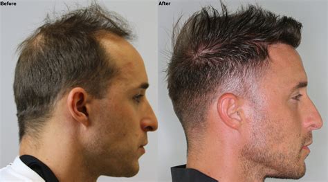 High Density Hairline Result Alvi Armani Hair Transplant Los Angeles