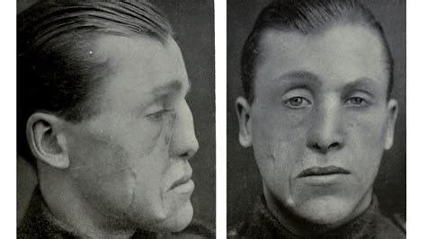 Innovative Cosmetic Surgery Restored Wwi Vets Ravaged Facesand Lives