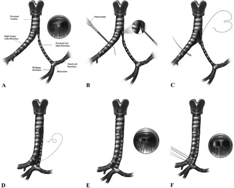 Technique of side-to-side tracheobronchoplasty. A Preoperative anatomy ...