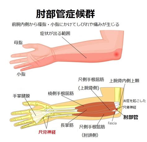 環指・小指のしびれを来たす尺骨神経障害「肘部管症候群」 長野整形外科クリニック