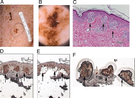 Xeroderma Pigmentosum Histology