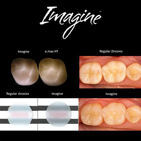 Realistic Monolithic Zirconia Made Easy Evident Digital