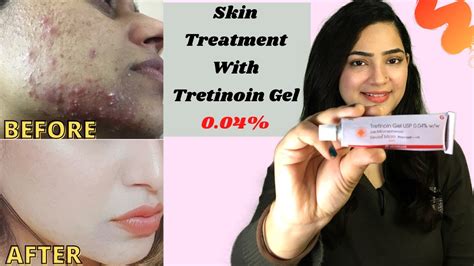 Tretinoin Gel Review Before And After Tretinoin Cream Review