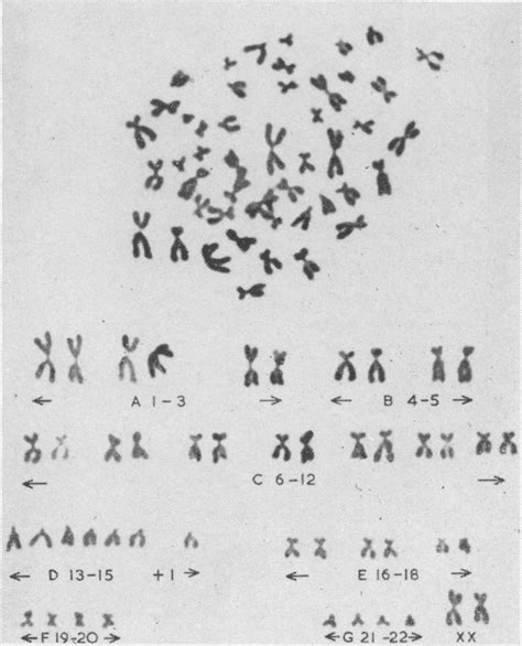 karyotype  present case  scientific diagram