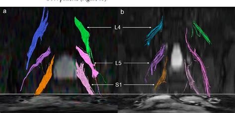 Figure 2 From Assessment Of Lumbosacral Nerve Roots In Patients With