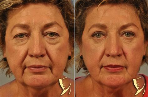 Blepharoplasty Upper And Lower Eyelid Surgery Dr Burke Robinson