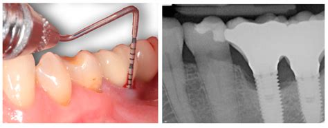 Jcm Free Full Text Understanding Peri Implantitis As A Plaque