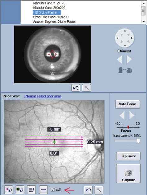 The Edi Module Cirrus Zeiss Hd Oct Is Marked With The Red Arrow