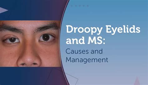 Droopy Eyelids and MS: Exploring the Link and How To Manage | MyMSTeam