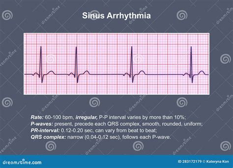 Electrocardiogram Ecg Displaying Sinus Arrhythmia 3d Illustration Stock Illustration