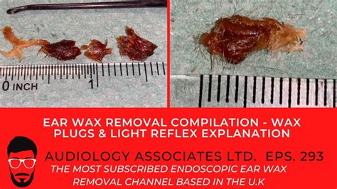 Ear Wax Removal Compilation Wax Plugs And Light Reflex Explanation Ep