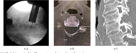 Figure 6 From Minimally Invasive Cervical Micro Endoscopic Foraminotomy