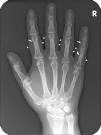 Psoriatic Arthritis | Radiology Key