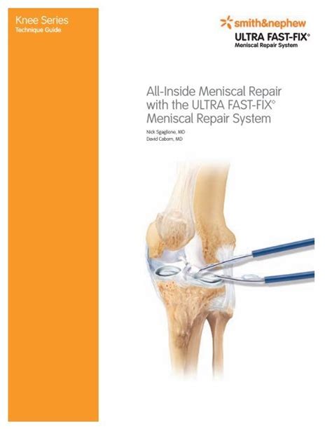 Ultra Fast Fix Meniscal Repair System Smith Nephew