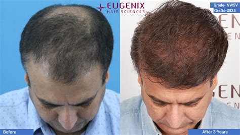 Norwood Scale 5v Baldness Hair Transplant And Treatment Uk