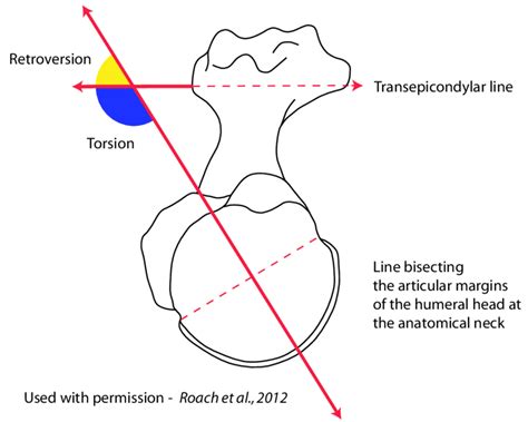 Humeral Head Retroversion Considerations Implant Biomechanics Anatomy