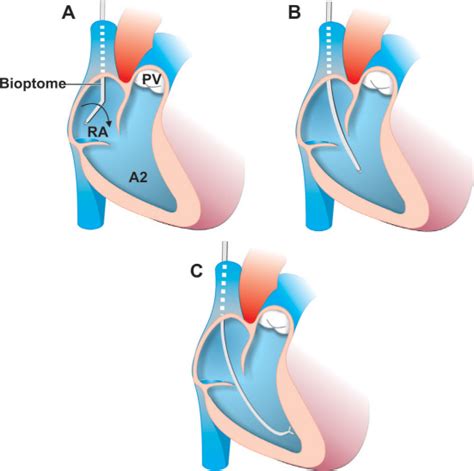 Endomyocardial Biopsy | Thoracic Key