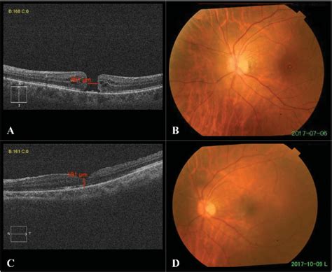 Full Thickness Macular Hole A Preoperative OCT Showing Stage 4