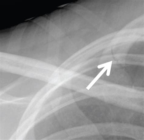 Rib Fracture Ct Scan