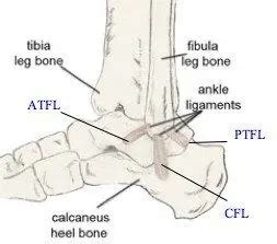 Inversion Ankle Sprain