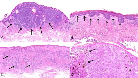 Facial Basal Cell Carcinoma The Bmj