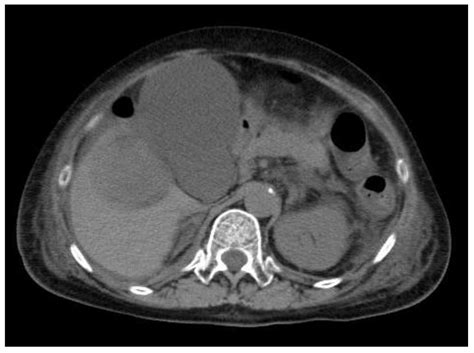 Life Threatening Acute Acalculous Cholecystitis In A Patient With Renal Cell Carcinoma Treated